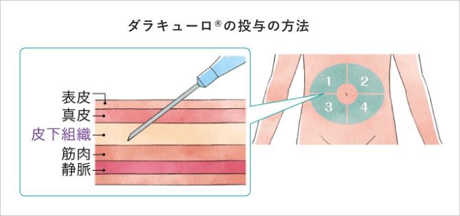 「ダラキューロ®の投与の方法」の説明画像